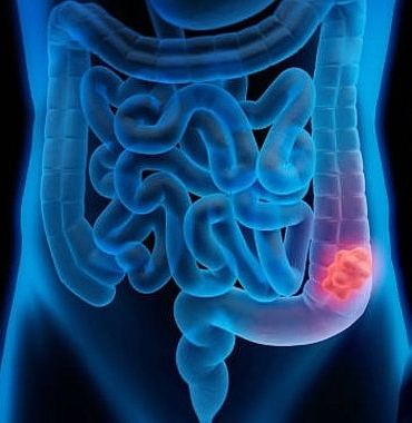 kolon-kanseri-belirti-vermeden-ilerleyebilir-erken-teshisle-sagliginizi-koruyun.jpg