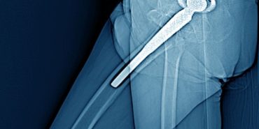 Robotik Kalça Protezi (1)