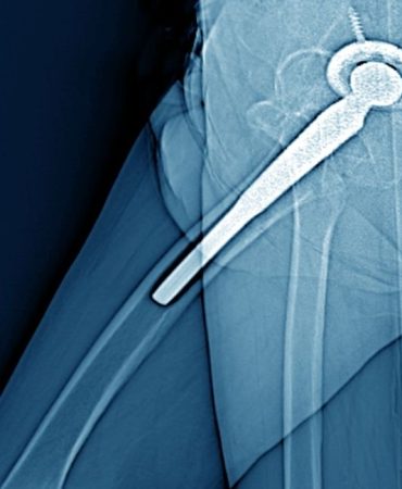 Robotik Kalça Protezi (1)