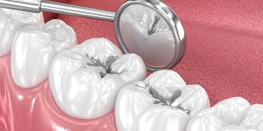 amalgam-dolgular-degistirilmeli-mi.jpg